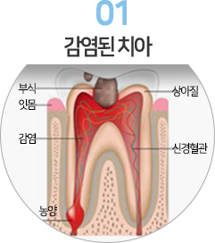 1. 감염된 치아