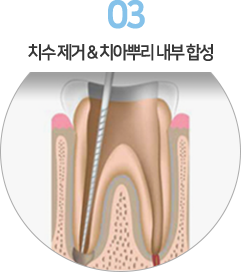 3. 치수 제거 & 치아뿌리 내부 합성