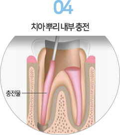 4. 치아 뿌리 내부 충전